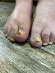 Болит большой палец на ноге, с грибковым ногтем фото 4