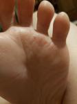Облазит кожа на ступняхи пальцах ног, не чешется, но побаливает фото 3