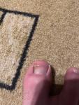 Утолщение ногтя пальца на ноге фото 1