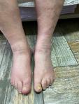 Болит большой палец на ноге, с грибковым ногтем фото 1