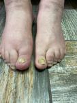Болит большой палец на ноге, с грибковым ногтем фото 2