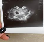 Па УЗИ не видно эмбрион фото 1