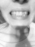 Верхние зубы. Виниры или брекеты фото 1