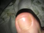 Грибок ногтей на пальце ноги фото 2