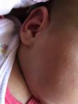 Сыпь на лице у младенца фото 2