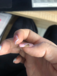 Потемнение ногтевой пластины, отслойка куском фото 2