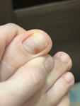 Коричневое пятно на ногте -это меланома? фото 4