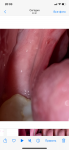 Слизистая рта после операции фото 2