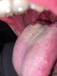 Появление шишки на корне языка, щипит фото 1