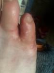 Прыщики на пальцах ног и жжение кожи фото 1