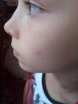 Красное выпуклое пятно на щеке у ребенка фото 1