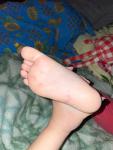 Пятна на ступнях у ребенка фото 2