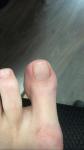 Зуд большого пальца ноги фото 2
