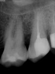 Точки у корня зуба на рентгене фото 1