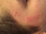 Аллергия на щеке фото 1