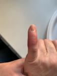 Болит и покраснел палец фото 3