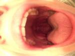 Шишка в горле, горло болит, на языке болят белые пупырышки фото 1