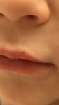 Красное пятно на губе у ребёнка фото 1