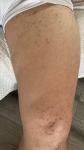 Гемаррологический васкулит с болью в коленях фото 2