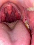Болит горло, миндалины фото 2