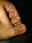 Болезнь ногтей на ногах фото 2