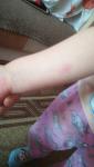 Покраснение в виде сыпи на одной руке у ребенка 4 года фото 1