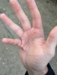 Дефект руки после травмы фото 4