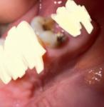 Выпада пломба, зуб разрушен фото 2