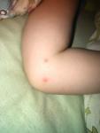Красные и белые твёрдые точки на теле у ребёнка фото 3