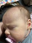 Акне новорожденных или аллергия? фото 4