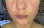 Высыпание на щеках похожее на аллергию фото 1