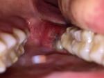 Воспаление капюшона (дёсны) над зубом мудрости фото 2