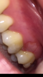 Язва на десне после лечения зуба фото 1