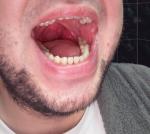 Біль у горлі, вухііл фото 3