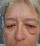 Мешок под глазом фото 1