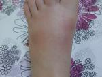 Боль в стопе, появились покраснения и синяки фото 1