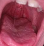 Большое белое пятно в горле фото 1