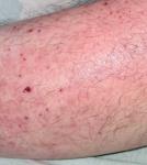 Чим лікувати сип на нозі? фото 2