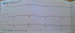 Тахикардия, возникающая внезапно фото 3