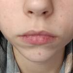 Припухлости под губами фото 4