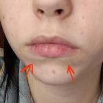 Припухлости под губами фото 1