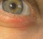 Воспаление нижнего века фото 1