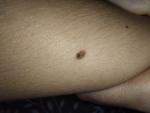 Странная родинка на руке фото 2
