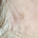 Что это? Ветрянка? фото 3