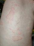 Красные пятна и волдыри на теле фото 3