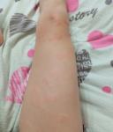 У меня появились какие-то зудящие волдыри фото 2