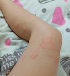 У меня появились какие-то зудящие волдыри фото 1