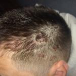 Бляшки на волосистой части головы фото 1