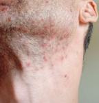 Красные прыщи на лице фото 4