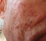 Красные прыщи на лице фото 3